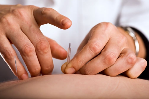 Acupuncture Treatments